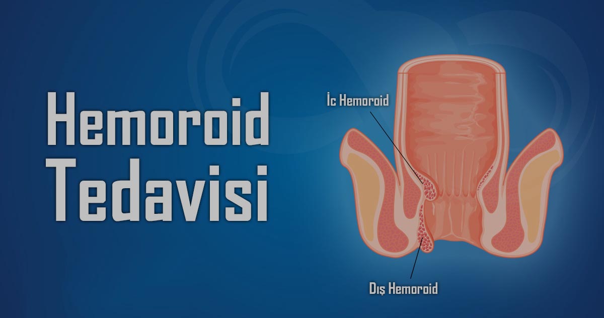 Hemoroid Bitkisel Tedavi